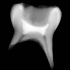 مادة سيليكات الكالسيوم المعدلة بالراتنج (ذات التصلد المزدوج) لعلاج بتر اللب (Pulpotomy)
